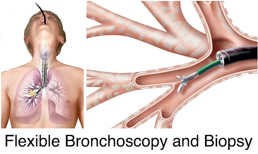 flexible bronchoscopy and biopsy