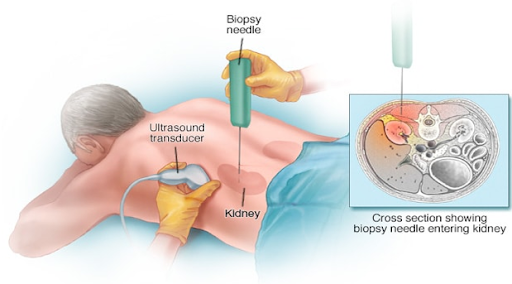 Schéma d'une biopsy